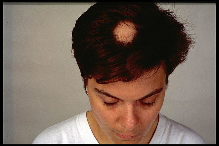 Alopecia areata Rueber